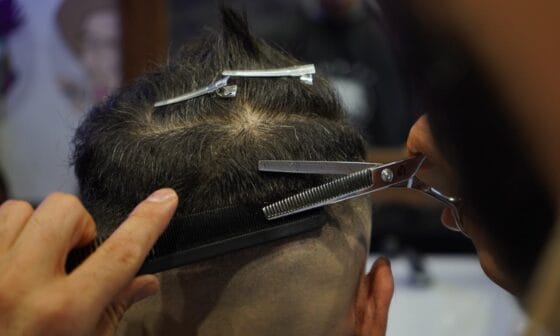 De Verschillende Methoden Van Haartransplantatie